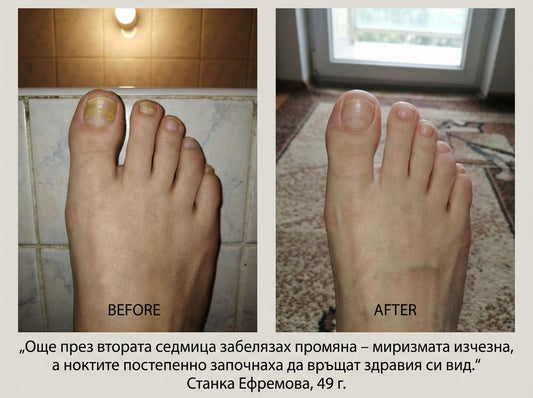 Пчелен мехлем при гъбички по ноктите и кожата