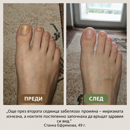 Пчелен мехлем при гъбички по ноктите и кожата