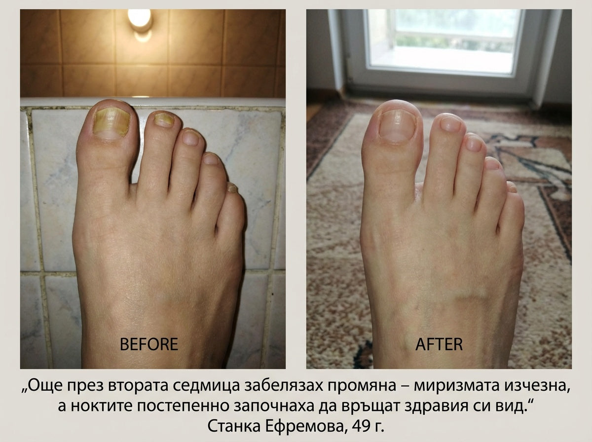 Пчелен мехлем при гъбички по ноктите и кожата